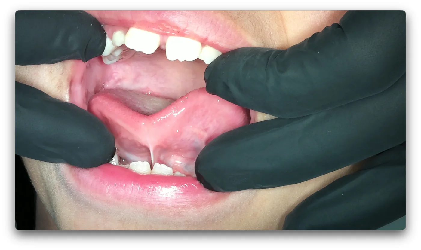 Restrictive lingual frenulum