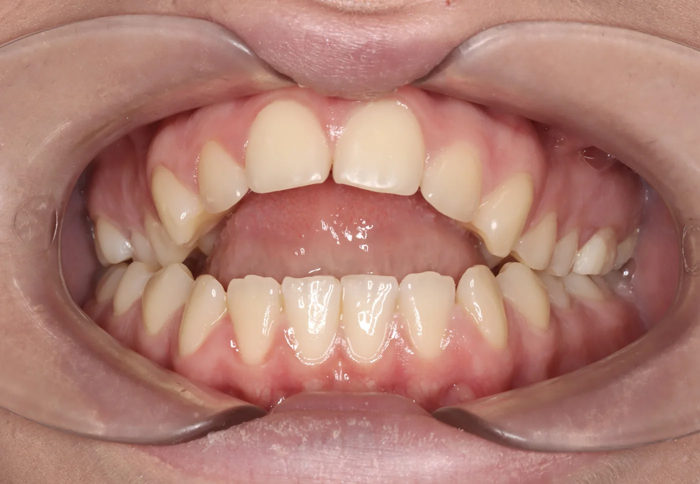 Anterior open bite