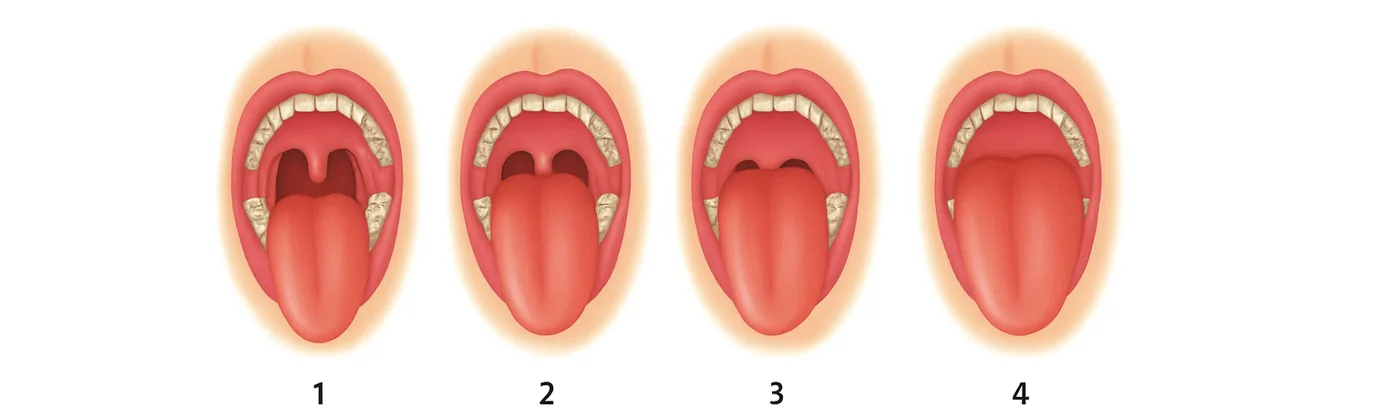 Score de Mallampati modifié